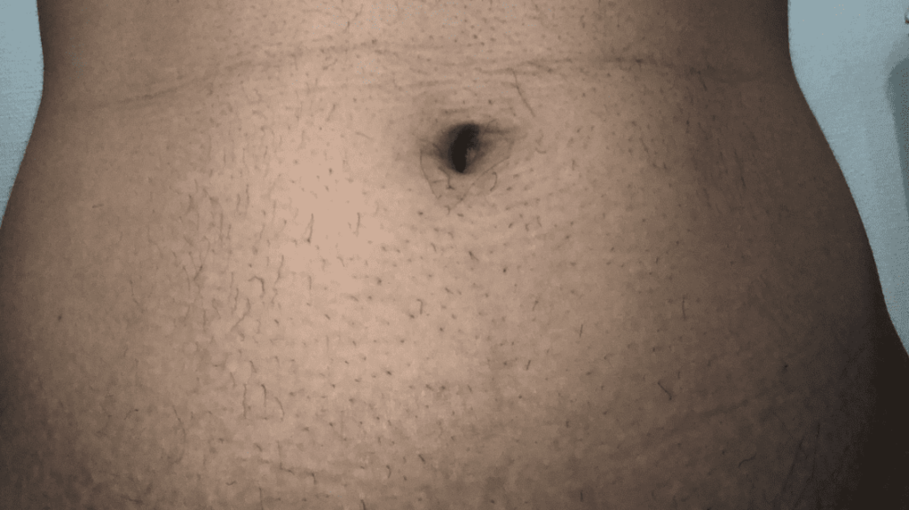 ゼロファクターの効果を検証 胸毛や腹毛で試してみました ゆえもんブログ