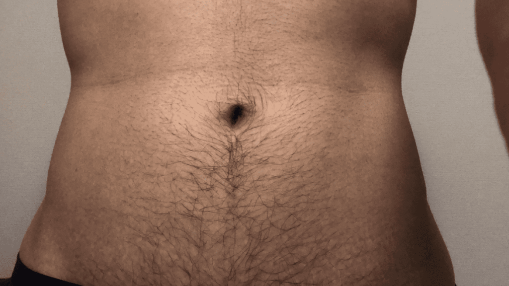 ゼロファクターの効果を検証 胸毛や腹毛で試してみました ゆえもんブログ